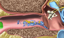将图片加载到图库查看器,Ear Wax Easy Remover